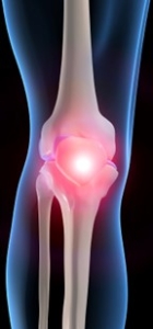 Patellofemoral Pain Runner’s Knee Carina