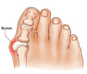 Bunions Big Toe Joint Pain treatment Carina