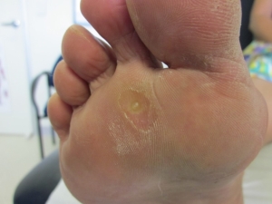 Corns & Calluses treatment in Carina