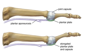 Metatarsalgia Forefoot Pain treatment in Carina