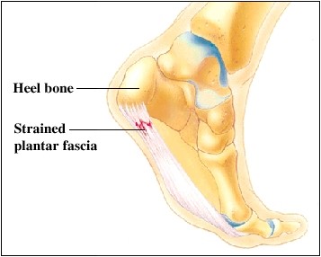 Plantar Fasciitis Plantar Heel Pain Carina Treatment